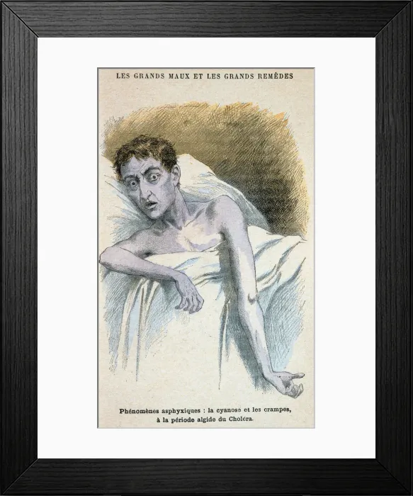 Framed Print : Cholera patient Framed Print : Cholera patient