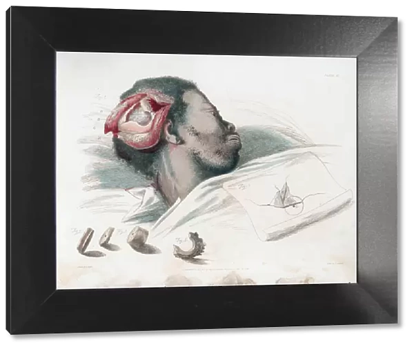 View of wound in skull after trephination and removal of shattered bone piece at bottom left, 1821. Artist: Thomas Landseer