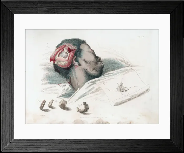 Framed Print : View of wound in skull after trephination and removal of shattered bone piece at bottom left, 1821. Artist: Thomas Landseer Framed Print : View of wound in skull after trephination and removal of shattered bone piece at bottom left, 1821. Artist: Thomas Landseer