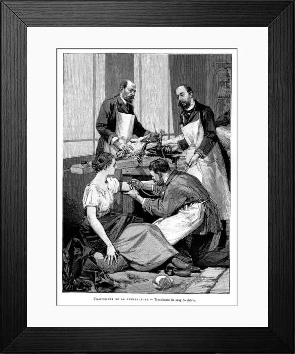 Framed Print : A tuberculosis patient being given a transfusion of goats blood, 1891 Framed Print : A tuberculosis patient being given a transfusion of goats blood, 1891