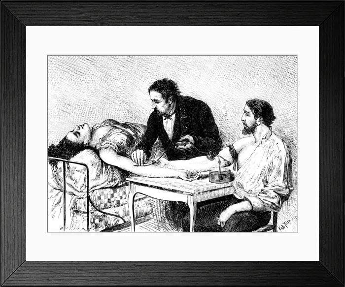 Framed Print : Dr Roussell of Geneva giving a woman a direct blood transfusion from a volunteer, 1882 Framed Print : Dr Roussell of Geneva giving a woman a direct blood transfusion from a volunteer, 1882