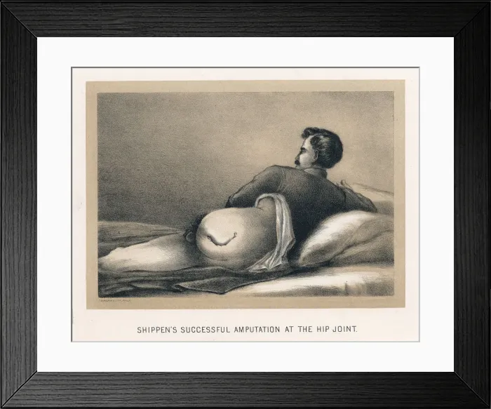 Framed Print : Shippens Successful Amputation at the Hip Joint, American Civil War, 1865 Framed Print : Shippens Successful Amputation at the Hip Joint, American Civil War, 1865