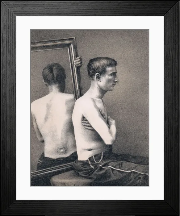 Framed Print : Recovering casualty of a bullet wound to the abdomen, American Civil War, 1865 Framed Print : Recovering casualty of a bullet wound to the abdomen, American Civil War, 1865