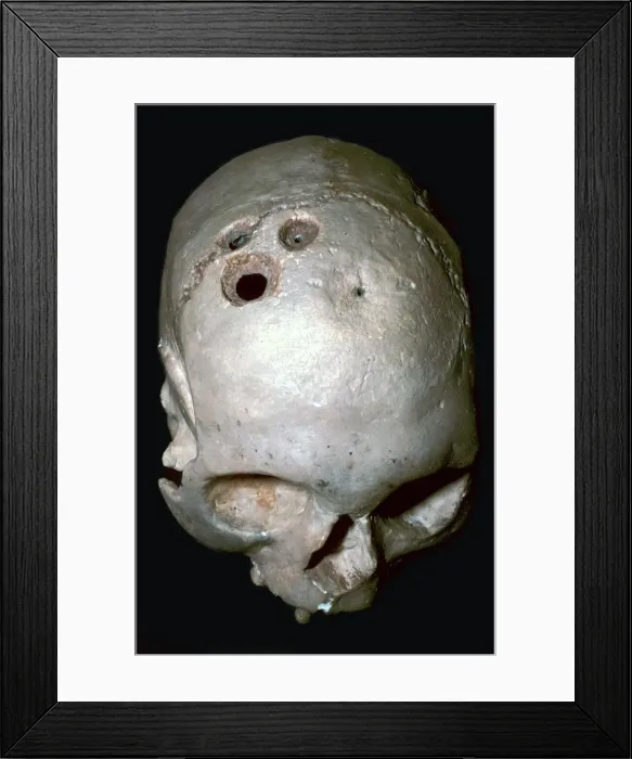 Framed Print : Trepanned Skull Framed Print : Trepanned Skull