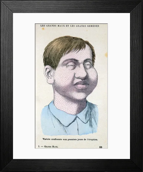 Framed Print : Smallpox victim, c1890 Framed Print : Smallpox victim, c1890