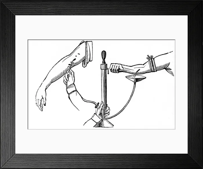 Framed Print : Person-to person blood transfusion, 1833 Framed Print : Person-to person blood transfusion, 1833