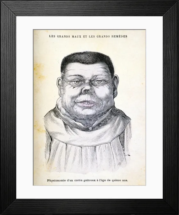 Framed Print : Cretin aged 15, c1890 Framed Print : Cretin aged 15, c1890