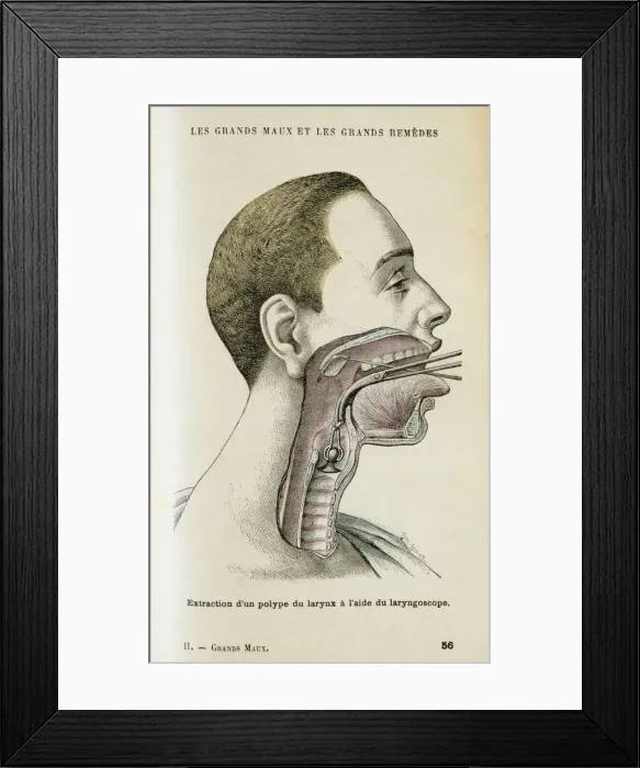 Framed Print : Using a laryngoscope to aid the removal of a polyp from the throat, c1890 Framed Print : Using a laryngoscope to aid the removal of a polyp from the throat, c1890
