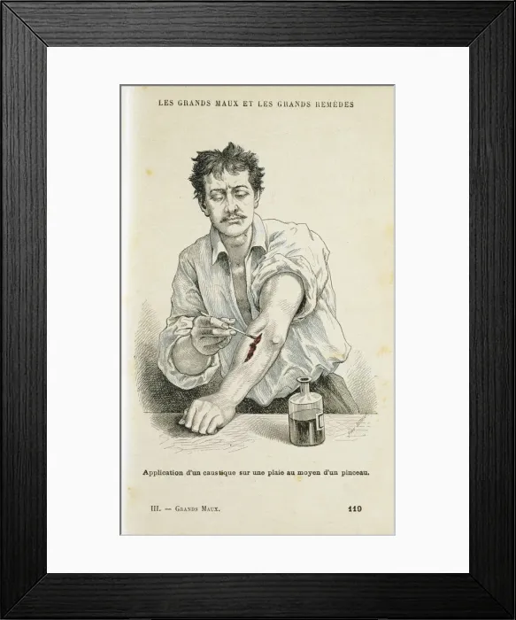 Framed Print : Painting a wound with an antiseptic solution, c1890 Framed Print : Painting a wound with an antiseptic solution, c1890