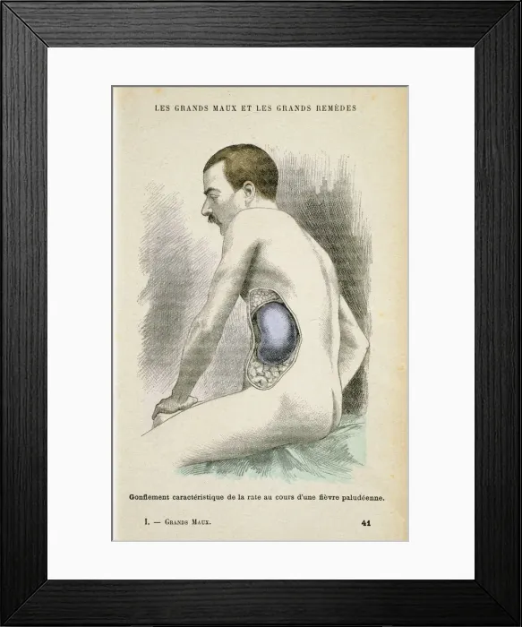 Framed Print : Typical enlarged spleen of a Malaria patient, c1890 Framed Print : Typical enlarged spleen of a Malaria patient, c1890