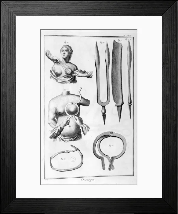 Framed Print : Breast surgery, 1751-1777 Framed Print : Breast surgery, 1751-1777