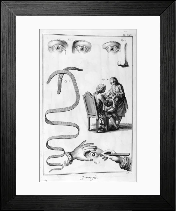 Framed Print : Eye surgery, 1751-1777 Framed Print : Eye surgery, 1751-1777