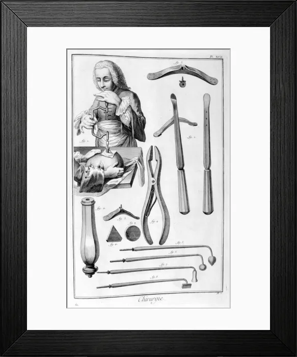 Framed Print : Head surgery, 1751-1777 Framed Print : Head surgery, 1751-1777