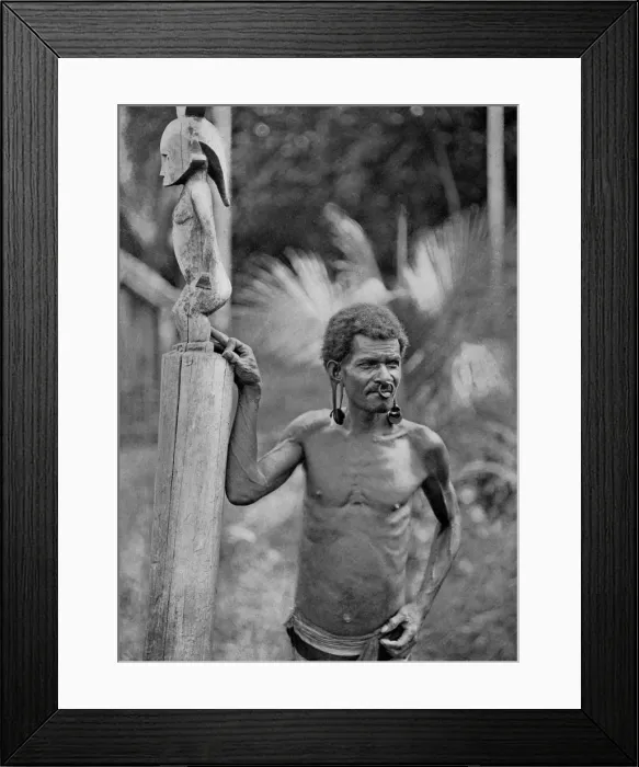 Framed Print : Malformation of the ears, Solomon Islands, 1920. Artist: JW Beattie Framed Print : Malformation of the ears, Solomon Islands, 1920. Artist: JW Beattie