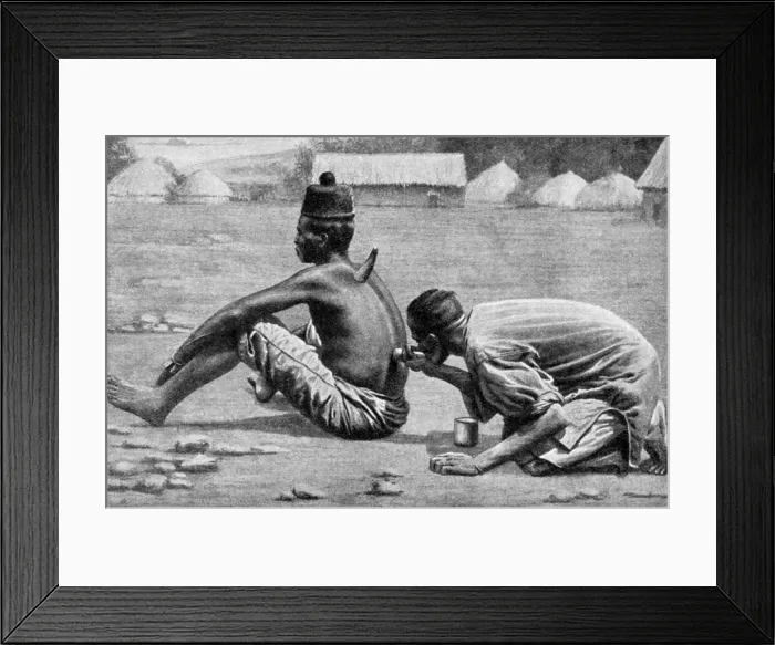 Framed Print : Cupping, wet and dry, as a therapeutic measure, Africa, 1922. Artist: FW Taylor Framed Print : Cupping, wet and dry, as a therapeutic measure, Africa, 1922. Artist: FW Taylor