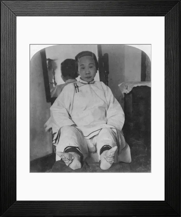 Framed Print : A high caste ladys dainty lily feet, showing method of deformity, China, 1900. Artist: Underwood & Underwood Framed Print : A high caste ladys dainty lily feet, showing method of deformity, China, 1900. Artist: Underwood & Underwood