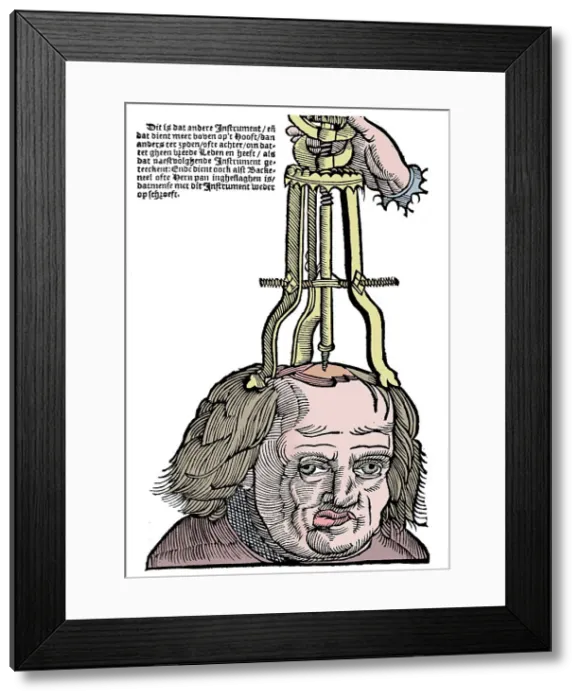 Framed Print : Trephination, 1593 Framed Print : Trephination, 1593