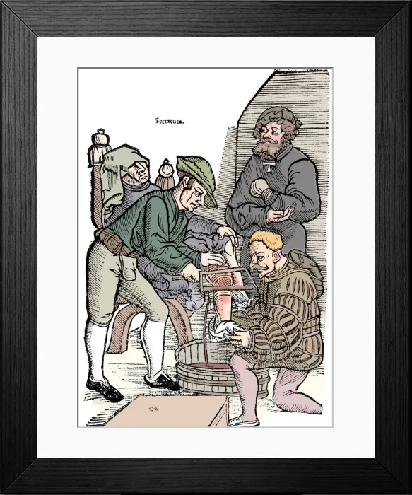 Framed Print : Amputation of a leg without anaesthetic, 1593 Framed Print : Amputation of a leg without anaesthetic, 1593