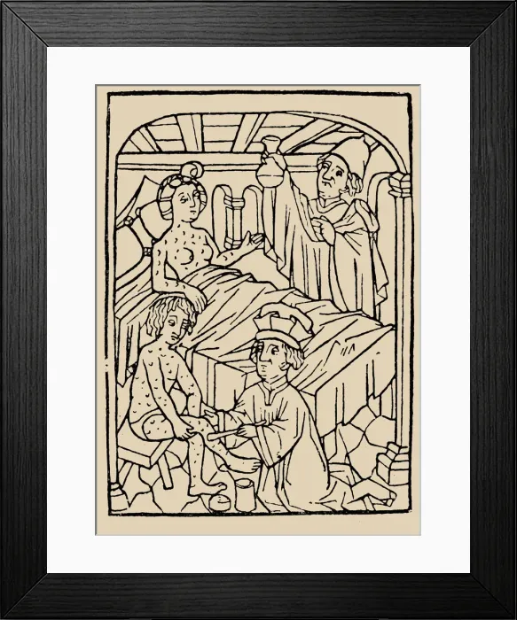 Framed Print : Syphilis treatment: Treatment with ointments (mercury). From: A Malafranczos morbo gallorum preserv Framed Print : Syphilis treatment: Treatment with ointments (mercury). From: A Malafranczos morbo gallorum preserv