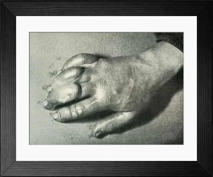 Framed Print : Dr. Atkinsons Frost-Bitten Hand, 5 July 1911, (1913). Artist: Herbert Ponting Framed Print : Dr. Atkinsons Frost-Bitten Hand, 5 July 1911, (1913). Artist: Herbert Ponting