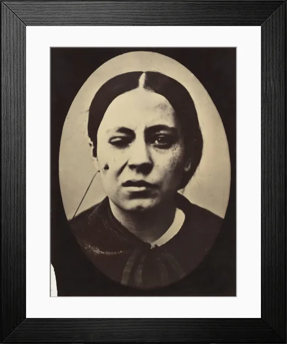 Framed Print : Figure 50: Affected weeping and face in repose, 1854-56, printed 1862