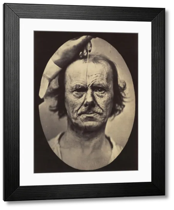 Framed Print : Figure 17: On the right, electrization of m. procerus: severity, aggressi Framed Print : Figure 17: On the right, electrization of m. procerus: severity, aggressi