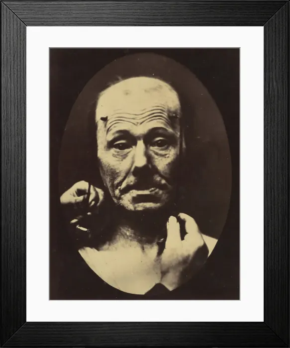 Framed Print : Figure 8: Contraction of the right m. frontalis. 1854-56, printed 1862 Framed Print : Figure 8: Contraction of the right m. frontalis. 1854-56, printed 1862