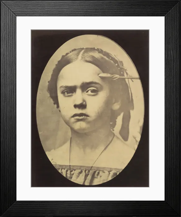 Framed Print : Figure 10: Showing the expressive lines of m. frontalis in a young girl, 1854-56 Framed Print : Figure 10: Showing the expressive lines of m. frontalis in a young girl, 1854-56