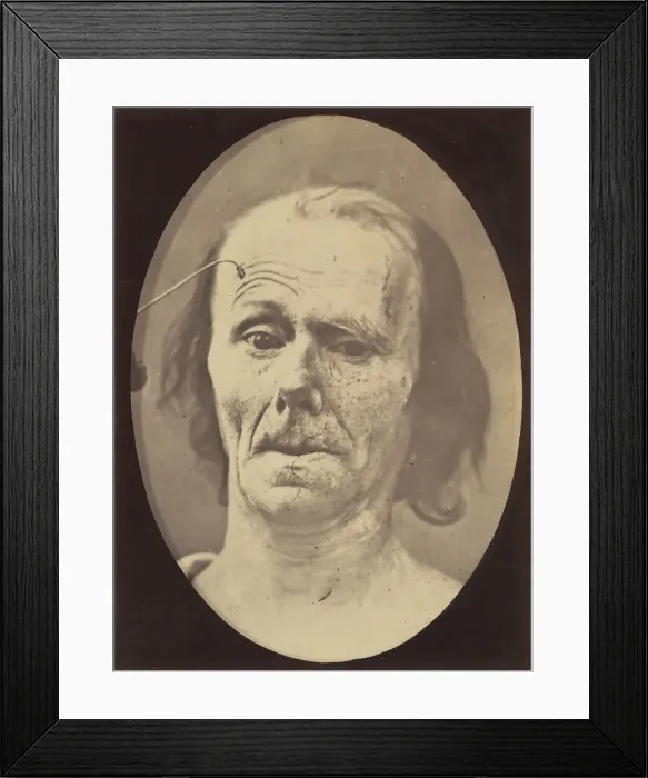 Framed Print : Figure 9: A study of m. frontalis in maximum contraction, 1854-56, printed 1862 Framed Print : Figure 9: A study of m. frontalis in maximum contraction, 1854-56, printed 1862