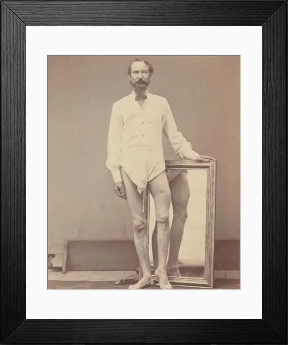 Framed Print : Gunshot Wound of Middle Third of Left Femur, 1865-67. Creator: William H. Bell Framed Print : Gunshot Wound of Middle Third of Left Femur, 1865-67. Creator: William H. Bell