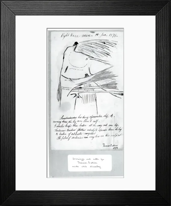 Framed Print : (Untitled) (Anatomical Study Of Right Knee), 1878. Creator: Thomas Eakins Framed Print : (Untitled) (Anatomical Study Of Right Knee), 1878. Creator: Thomas Eakins