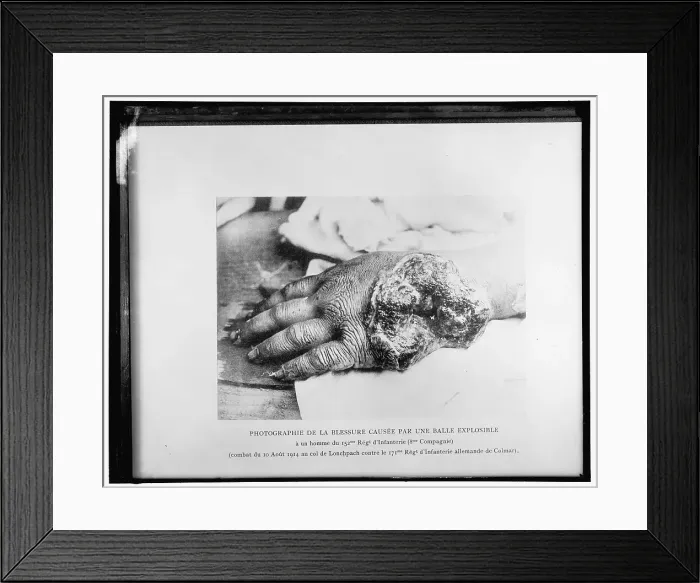 Framed Print : Photographie de la blessure causée par une balle explosible... 1914. Creator: Harris & Ewing. Photographie de la blessure causée par une balle explosible... 1914. Creator: Harris & Ewing Framed Print : Photographie de la blessure causée par une balle explosible... 1914. Creator: Harris & Ewing. Photographie de la blessure causée par une balle explosible... 1914. Creator: Harris & Ewing