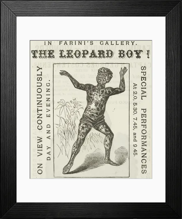 Framed Print : The Leopard Boy! in Farini's Gallery, 1881. Creator: Unknown. The Leopard Boy! in Farini's Gallery, 1881. Creator: Unknown Framed Print : The Leopard Boy! in Farini's Gallery, 1881. Creator: Unknown. The Leopard Boy! in Farini's Gallery, 1881. Creator: Unknown