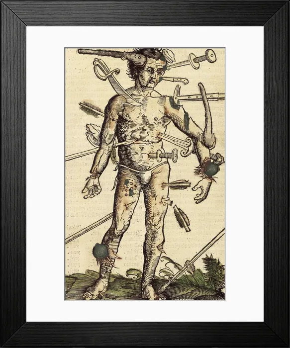 Framed Print : The wound man, 1517. Creator: Hans Wechtlin the Elder Framed Print : The wound man, 1517. Creator: Hans Wechtlin the Elder