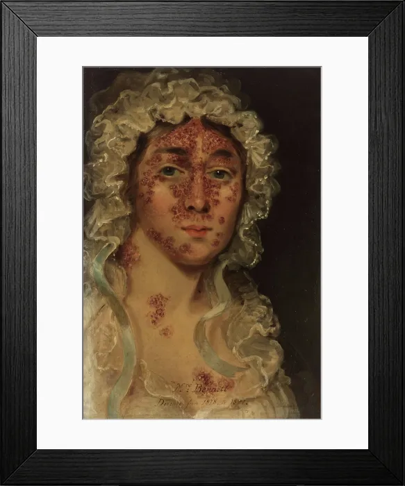 Framed Print : Mrs Bennett, afflicted with a skin disease, between 1818 and 1821. Creator: Unknown Framed Print : Mrs Bennett, afflicted with a skin disease, between 1818 and 1821. Creator: Unknown