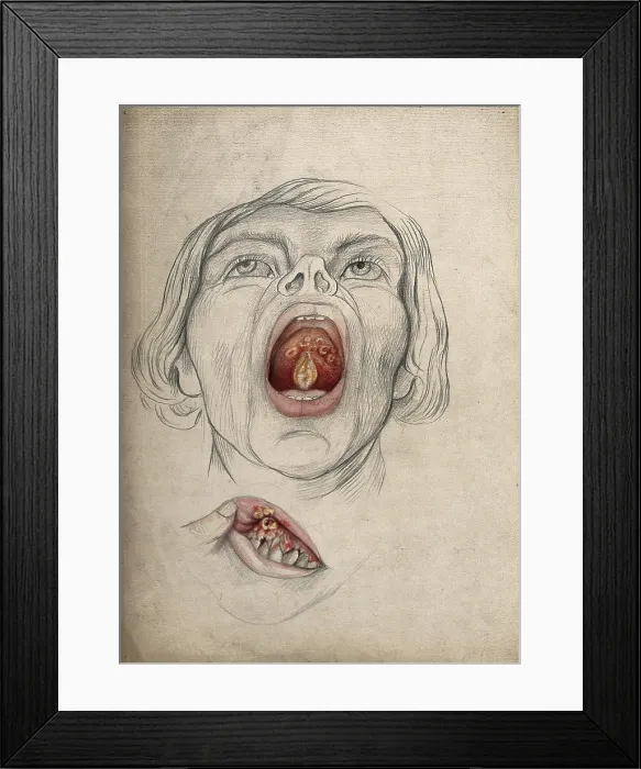 Framed Print : The face of a man, with mouth open wide, displaying diseased areas of... between 1800 and 1899. Creator: Christopher D'Alton. The face of a man, with mouth open wide, displaying diseased areas of... between 1800 and 1899 Framed Print : The face of a man, with mouth open wide, displaying diseased areas of... between 1800 and 1899. Creator: Christopher D'Alton. The face of a man, with mouth open wide, displaying diseased areas of... between 1800 and 1899