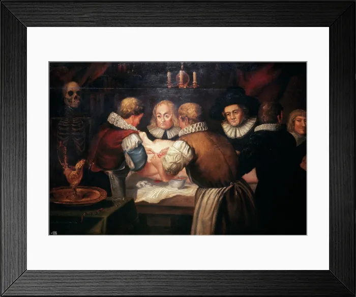 Framed Print : Surgeons performing an operation on a woman's breast in the seventeenth century. Creator: Unknown. Surgeons performing an operation on a woman's breast in the seventeenth century. Creator: Unknown Framed Print : Surgeons performing an operation on a woman's breast in the seventeenth century. Creator: Unknown. Surgeons performing an operation on a woman's breast in the seventeenth century. Creator: Unknown