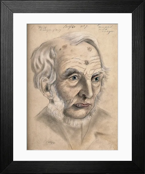 Framed Print : A man suffering from chancre of the lip, displaying scar tissue on his lower lip, forehead... 1867. Creator: Christopher D'Alton. A man suffering from chancre of the lip, displaying scar tissue on his lower lip, forehead... 1867 Framed Print : A man suffering from chancre of the lip, displaying scar tissue on his lower lip, forehead... 1867. Creator: Christopher D'Alton. A man suffering from chancre of the lip, displaying scar tissue on his lower lip, forehead... 1867