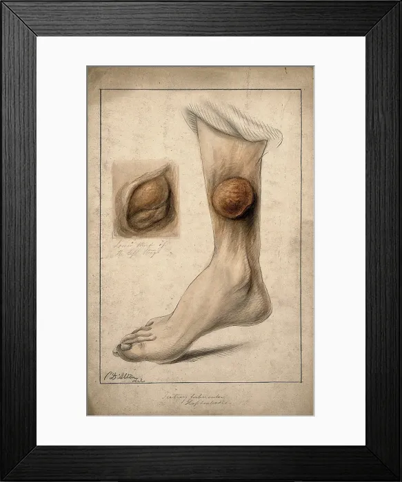 Framed Print : Tertiary tubercular elephantiasis on the thigh and calf of a woman, 1874. Creator: Christopher D'Alton. Tertiary tubercular elephantiasis on the thigh and calf of a woman, 1874. Creator: Christopher D'Alton Framed Print : Tertiary tubercular elephantiasis on the thigh and calf of a woman, 1874. Creator: Christopher D'Alton. Tertiary tubercular elephantiasis on the thigh and calf of a woman, 1874. Creator: Christopher D'Alton