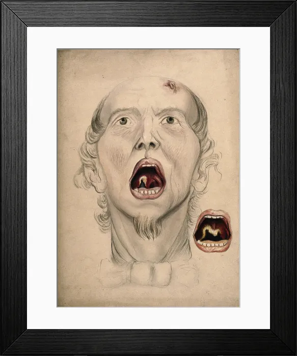 Framed Print : The face of a man, with mouth open wide, displaying a diseased area of tissue on the soft... 1866. Creator: Christopher D'Alton. The face of a man, with mouth open wide, displaying a diseased area of tissue on the soft... 1866