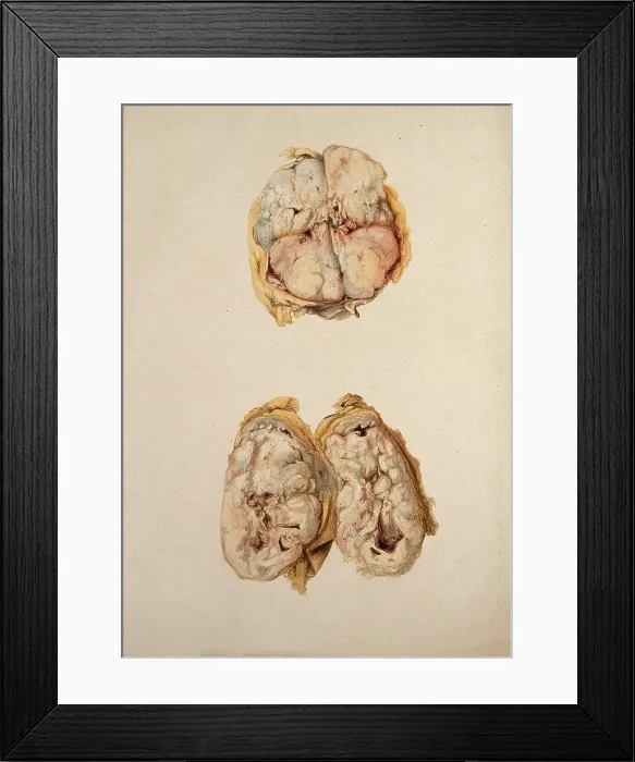 Framed Print : Two diseased parts of the body. Creator: Unknown Framed Print : Two diseased parts of the body. Creator: Unknown