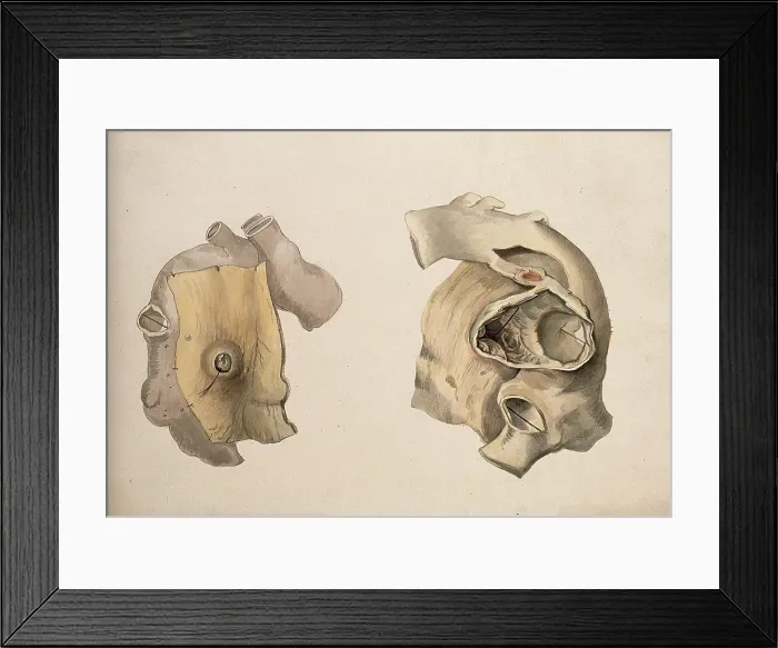 Framed Print : Two diseased parts of the body. Creator: Unknown Framed Print : Two diseased parts of the body. Creator: Unknown