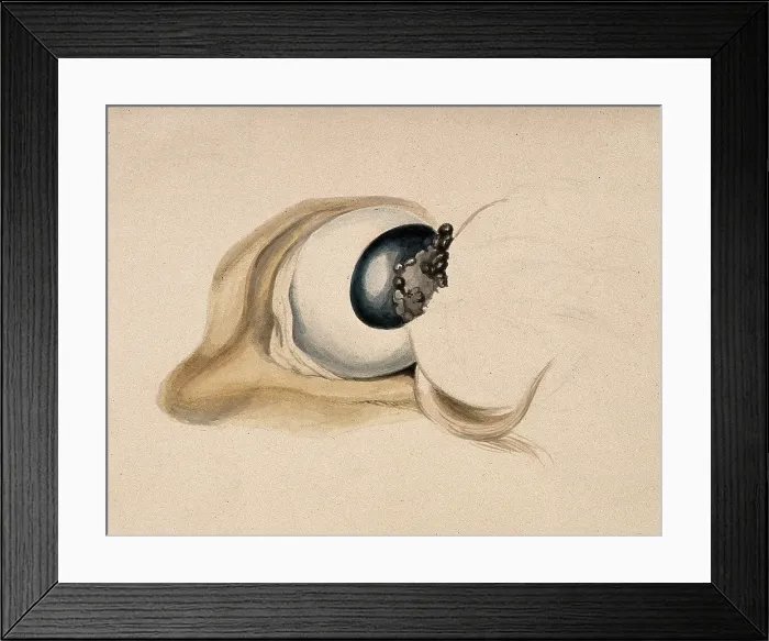 Framed Print : A diseased eye. Creator: Unknown