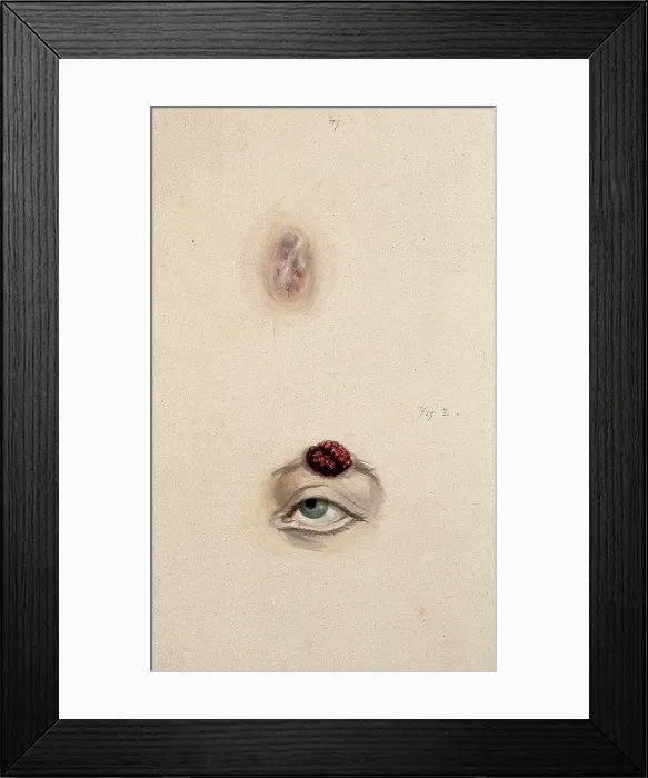 Framed Print : A section of a child's diseased forehead (detail); and a child's diseased eyebrow... 1829. Creator: Unknown. A section of a child's diseased forehead (detail); and a child's diseased eyebrow... 1829. Creator: Unknown Framed Print : A section of a child's diseased forehead (detail); and a child's diseased eyebrow... 1829. Creator: Unknown. A section of a child's diseased forehead (detail); and a child's diseased eyebrow... 1829. Creator: Unknown