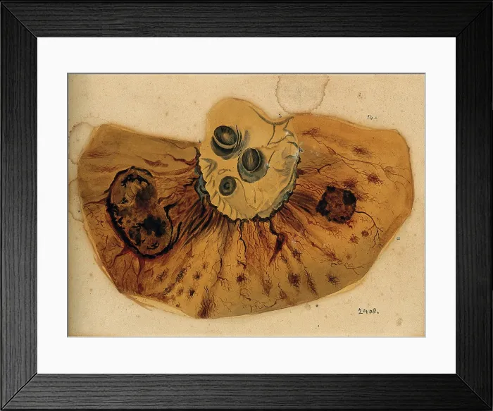 Framed Print : A section of diseased intestine or heart, 1800-1850. Creator: Richard Bright Framed Print : A section of diseased intestine or heart, 1800-1850. Creator: Richard Bright