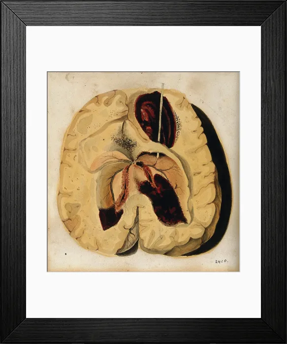 Framed Print : A diseased brain, 1800-1850. Creator: Richard Bright Framed Print : A diseased brain, 1800-1850. Creator: Richard Bright