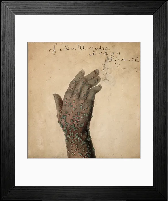Framed Print : Rash of pustules on the hand of a patient, probably suffering from smallpox, 1831. Creator: Robert Carswell Framed Print : Rash of pustules on the hand of a patient, probably suffering from smallpox, 1831. Creator: Robert Carswell