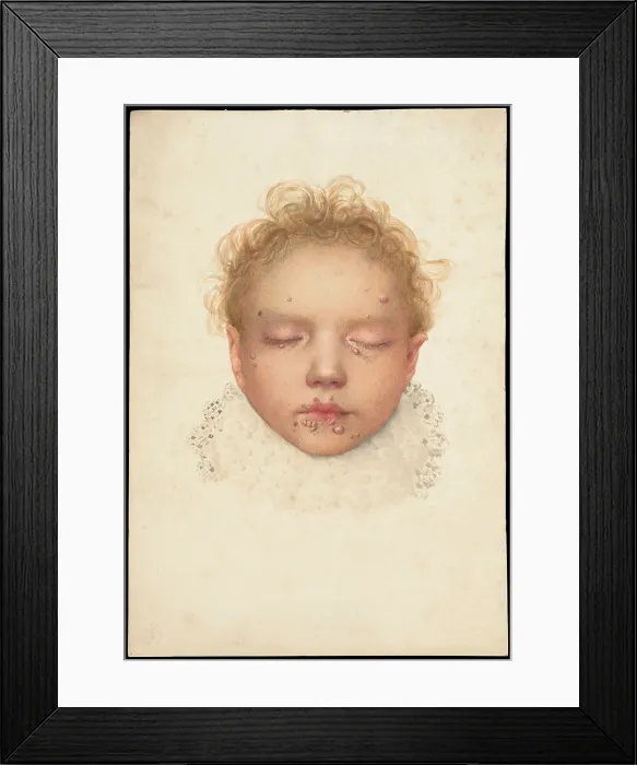 Framed Print : Head of a child with closed eyes and skin disease on the face, 1892. Creator: Unknown Framed Print : Head of a child with closed eyes and skin disease on the face, 1892. Creator: Unknown