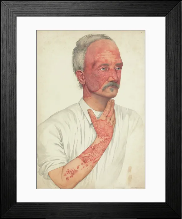 Framed Print : A man with disease designated as Lupus erythematosus, 1902. Creator: Mabel Green Framed Print : A man with disease designated as Lupus erythematosus, 1902. Creator: Mabel Green