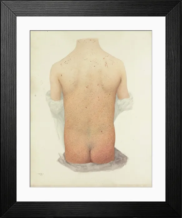 Framed Print : Back of a boy with skin disease, 1891. Creator: W Toogood Hill Framed Print : Back of a boy with skin disease, 1891. Creator: W Toogood Hill
